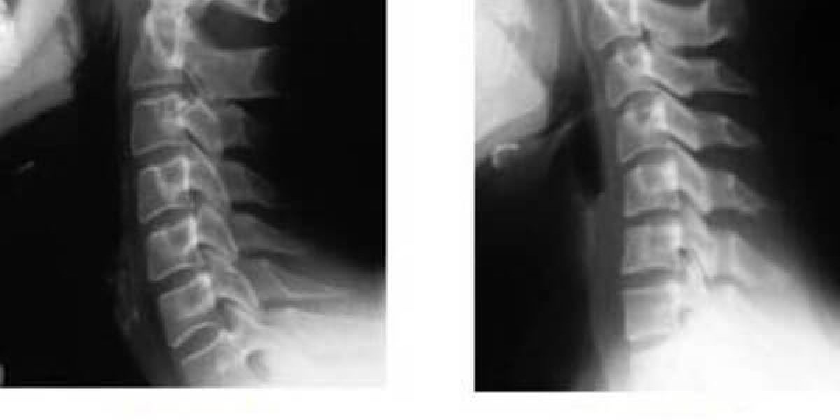 Verticalizzazione Cervicale: cos'è e come guarire efficacemente!