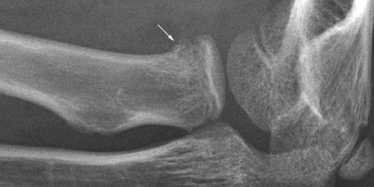 Frattura Capitello Radiale: Anatomia, Cause e Sintomi ...